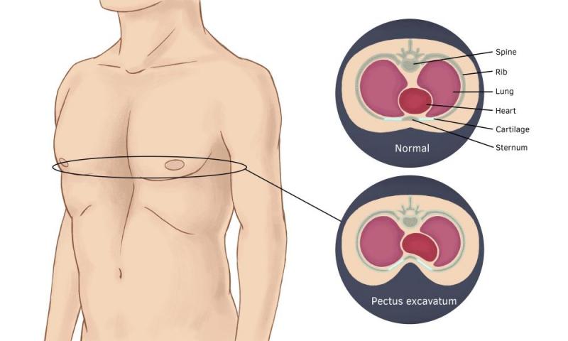 Bệnh lõm ngực có tác hại gì