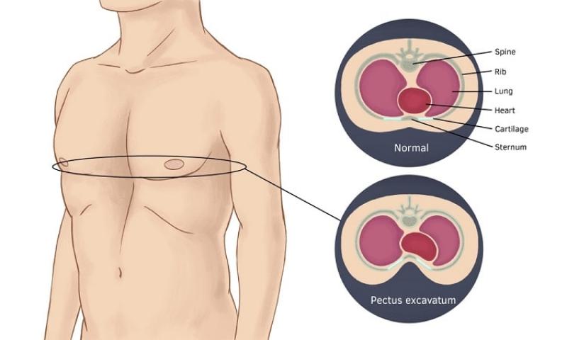 Lõm ngực Lõm ngực
