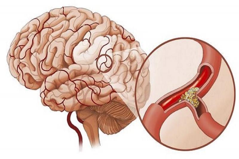 Tai biến mạch máu não - Đột quỵ