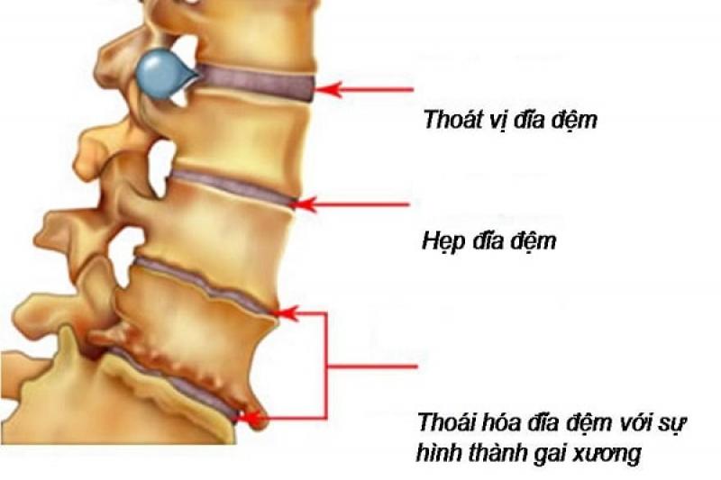 Thoái hóa cột sống Thoái hóa cột sống