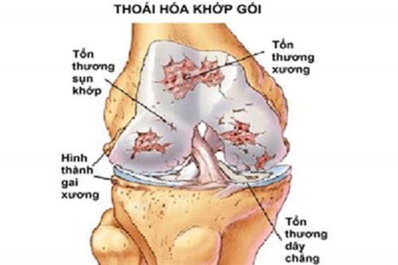 Thoái hóa khớp gối Thoái hóa khớp gối