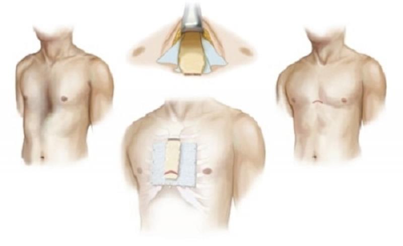 Bị bệnh lõm ngực có nên điều trị bằng phẫu thuật không?