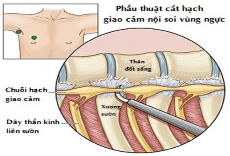 Bị đổ mồ hôi tay chân có nên cắt hạch thần kinh giao cảm không?