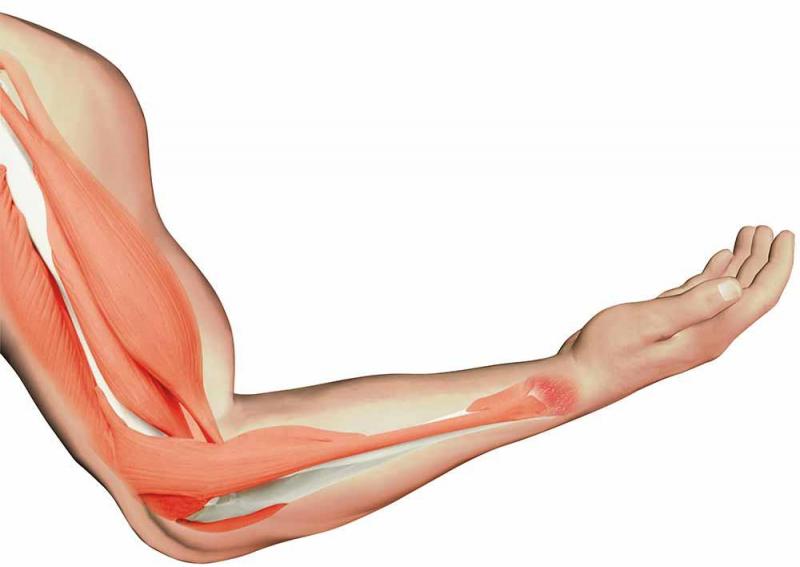 Cơ bắp tay bị co giật - Nguyên nhân và cách phòng ngừa