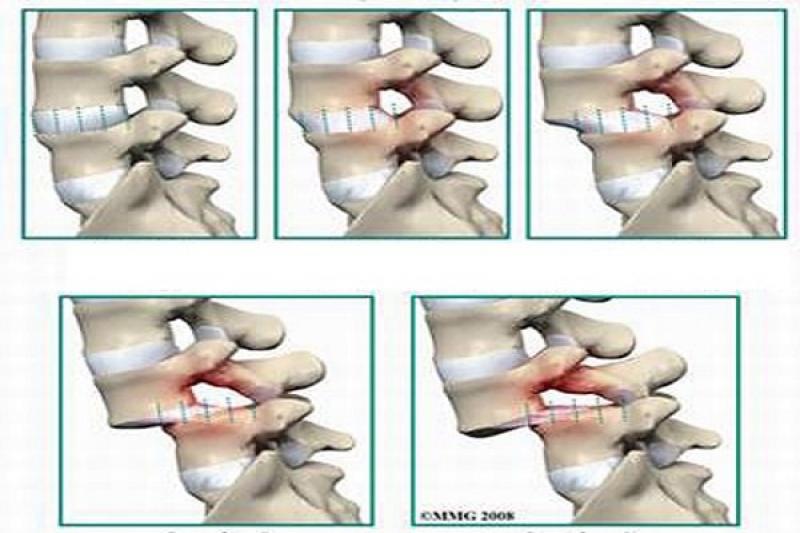 Biện pháp điều trị bệnh thoát vị đĩa đệm cột sống Biện pháp điều trị bệnh thoát vị đĩa đệm cột sống