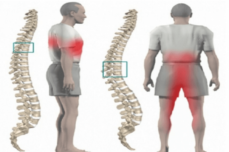 Biện pháp phòng tránh bệnh thoát vị đĩa đệm cột sống Biện pháp phòng tránh bệnh thoát vị đĩa đệm cột sống