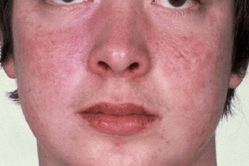 Các biện pháp phòng chống bệnh Lupus ban đỏ hệ thống Các biện pháp phòng chống bệnh Lupus ban đỏ hệ thống
