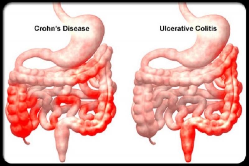 Các biện pháp phòng chống bệnh viêm ruột Crohn