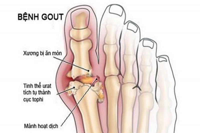 Các cách điều trị và phương pháp chữa bệnh Gout