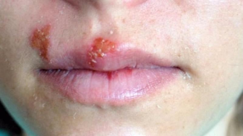 Các dấu hiệu và triệu chứng của bệnh HIV giai đoạn cuối