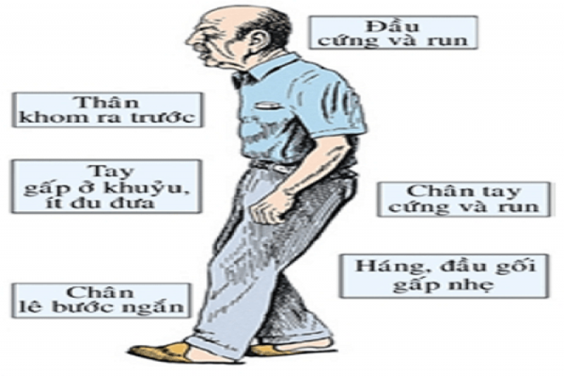 Các dấu hiệu, biểu hiện và triệu chứng của bệnh Parkinson