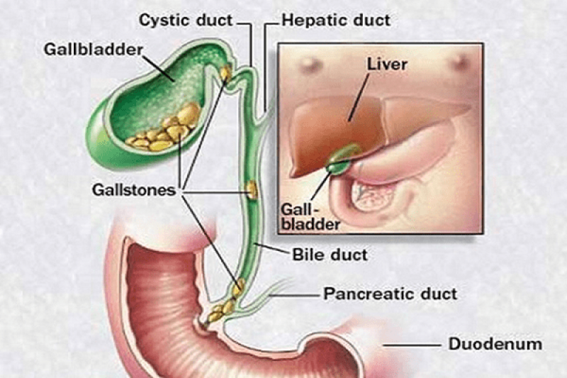 Cách điều trị chữa bệnh viêm tụy cấp và viêm tụy mạn