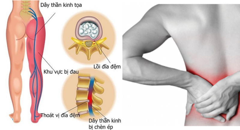 Cách điều trị đau thần kinh tọa