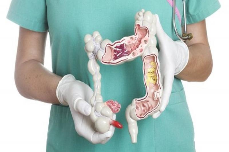 Cách điều trị và chữa bệnh viêm ruột Crohn hiện nay Cách điều trị và chữa bệnh viêm ruột Crohn hiện nay
