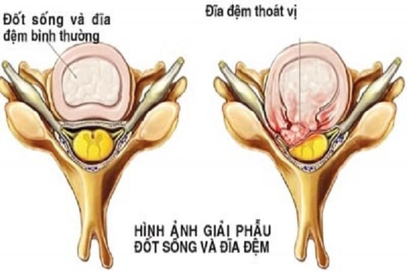 Cách điều trị và phòng chống bệnh thoát vị đĩa đệm cột sống cổ