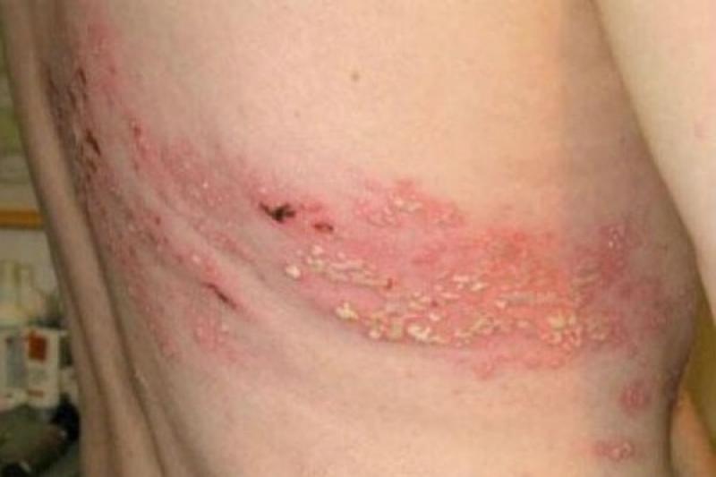 Cách phân biệt bệnh Zona thần kinh và thủy đậu