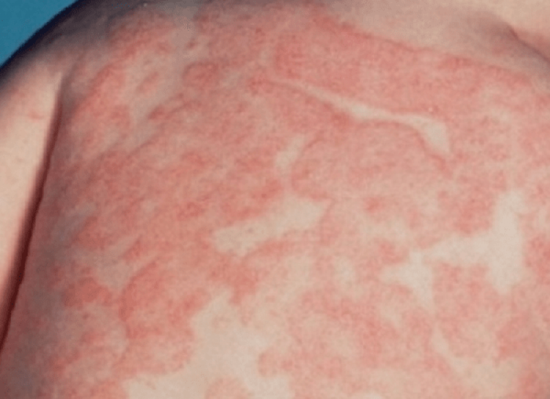 Chàm - Eczema