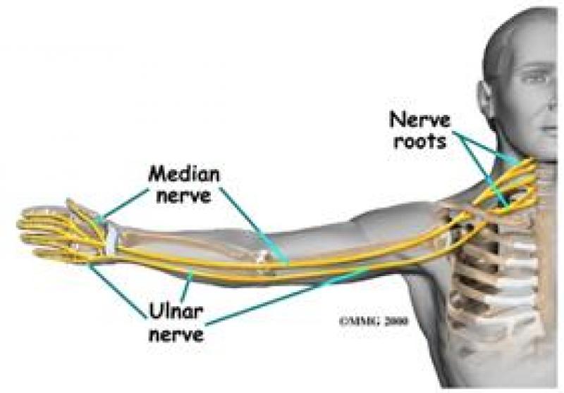 Chèn ép thần kinh cánh tay Chèn ép thần kinh cánh tay