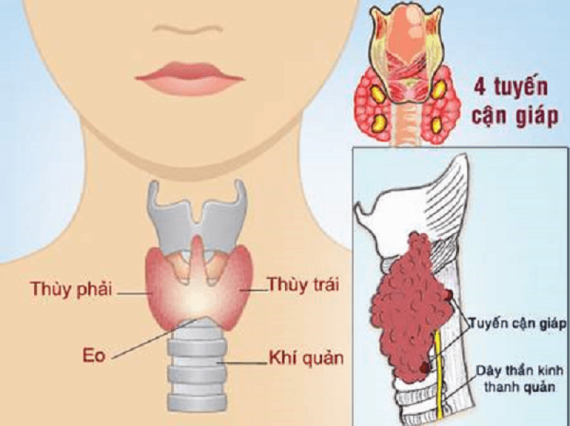 Có nên mổ bướu cổ không? Vì sao phải mổ bướu cổ?