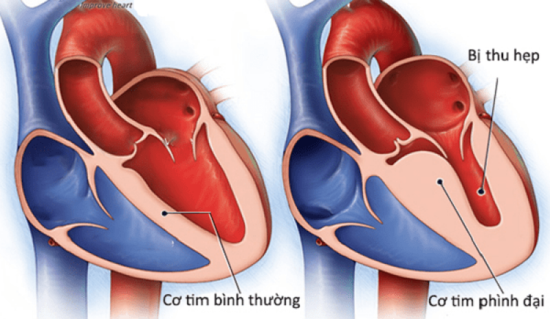 Cơ tim phì đại