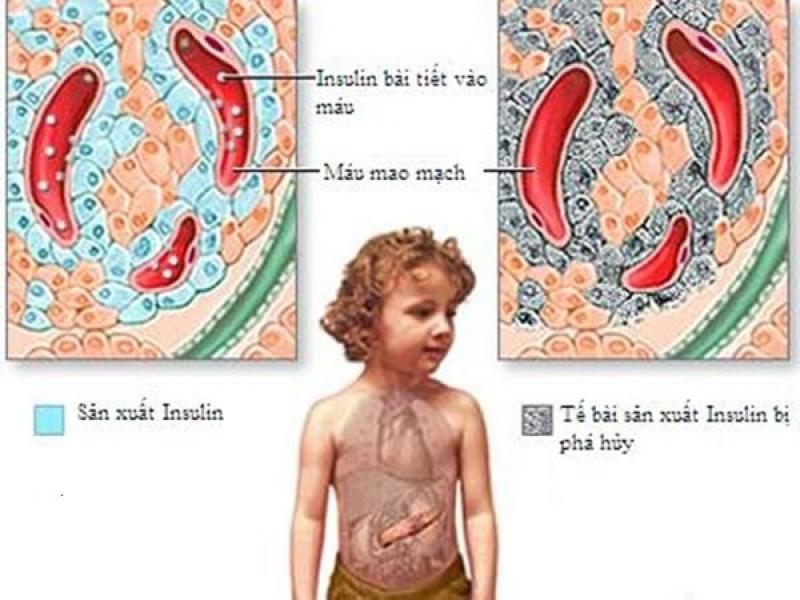 Đái tháo đường tuýp 1 - tiểu đường phụ thuộc In-su-lin