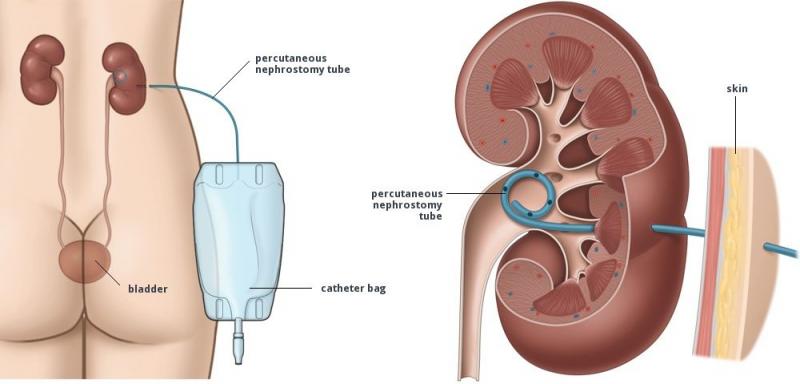 Dẫn lưu thận qua da dưới hướng dẫn của siêu âm