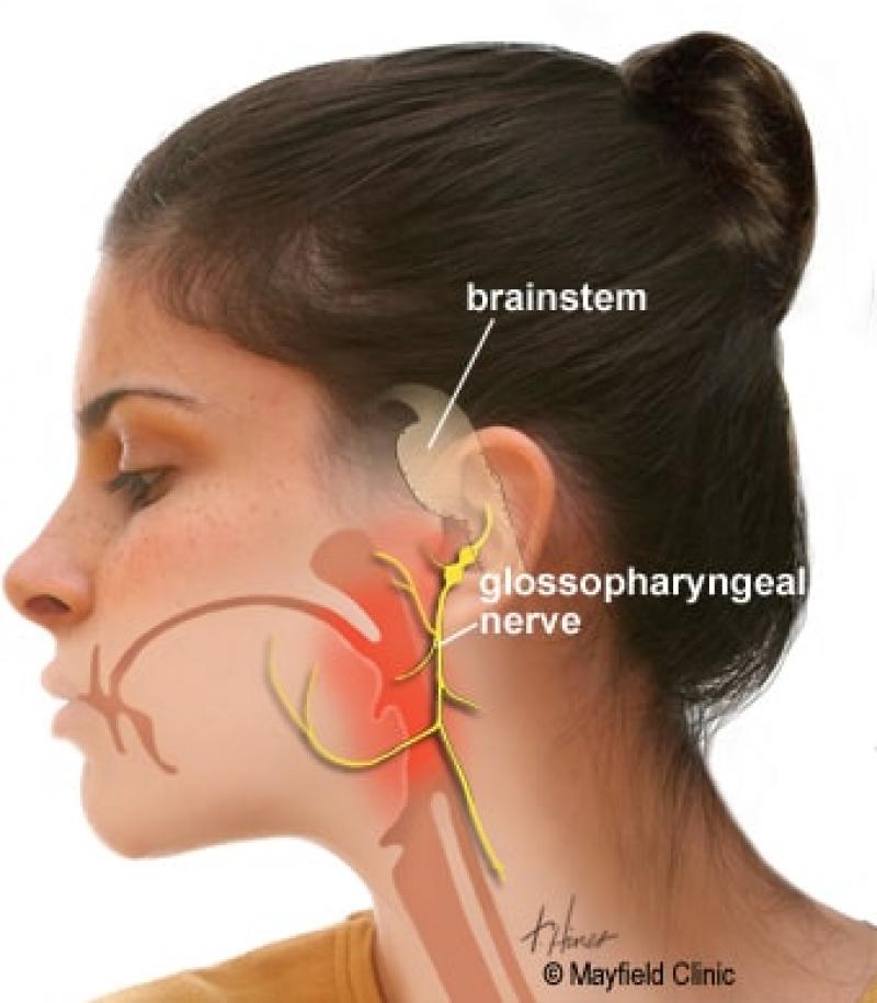 Đau dây thần kinh thiệt hầu - đau dây thần kinh số 9