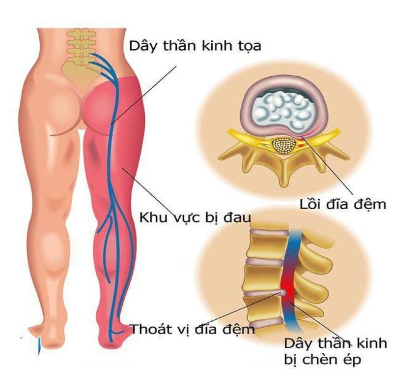 Đau dây thần kinh tọa ở chân