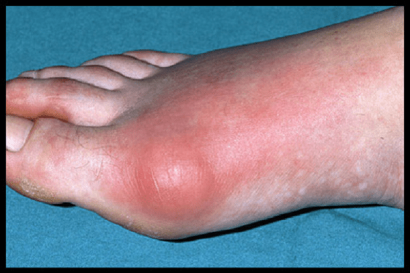 Dấu hiệu, biểu hiện và triệu chứng của bệnh gout là gì