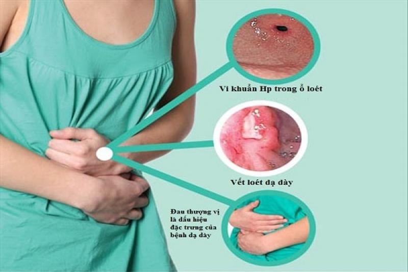 Dấu hiệu và triệu chứng của bệnh viêm loét dạ dày tá tràng