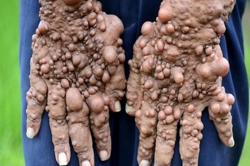 Dấu hiệu và triệu chứng của bệnh u sợi thần kinh