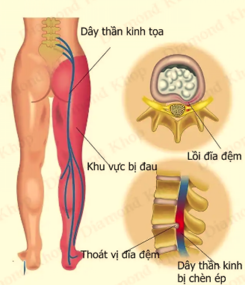 Đau thần kinh tọa kiêng ăn gì Đau thần kinh tọa kiêng ăn gì