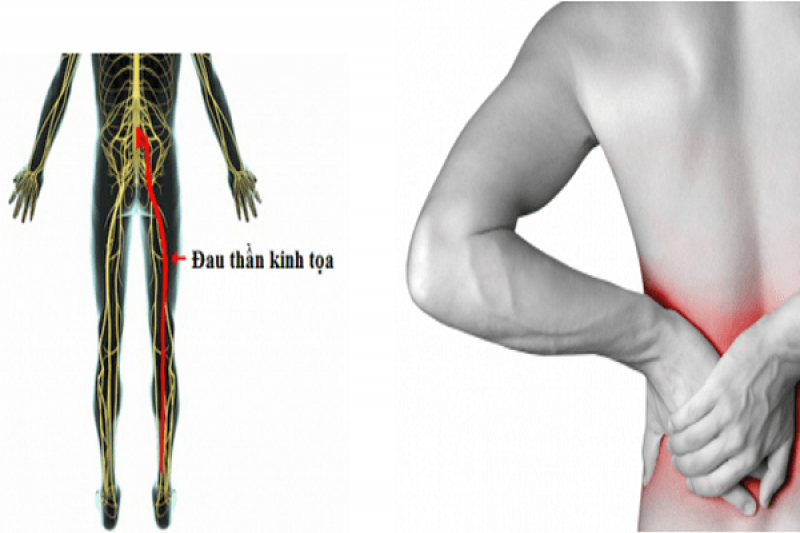 Đau thần kinh tọa Đau thần kinh tọa