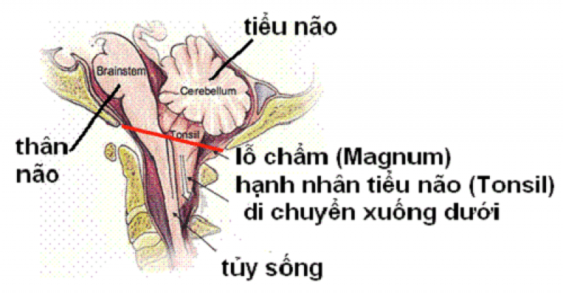 Dị dạng Chiari
