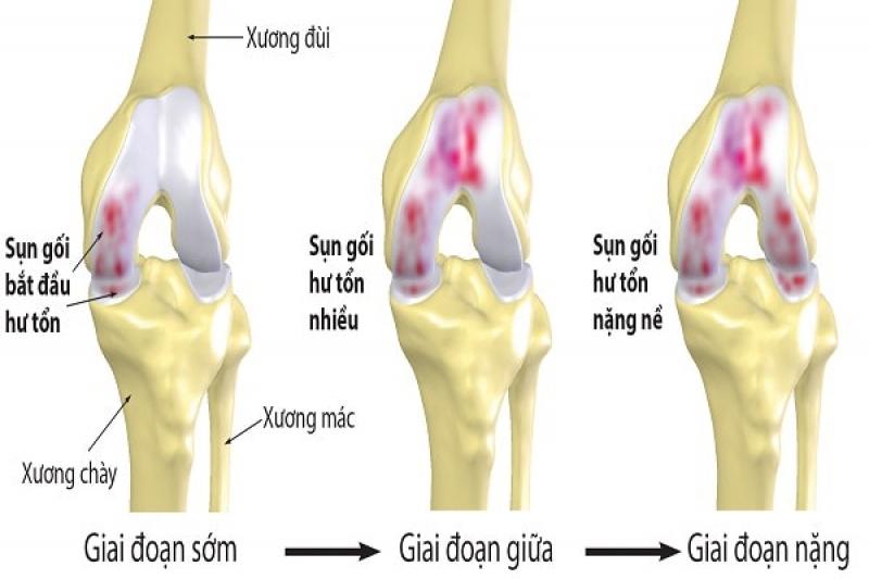 Các cách điều trị chữa bệnh thoái hóa khớp gối hiện nay