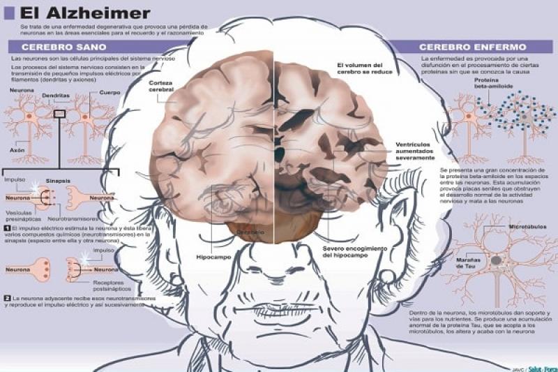 Điều trị hội chứng mất trí nhớ thường xuyên alzheimer như thế nào Điều trị hội chứng mất trí nhớ thường xuyên alzheimer như thế nào
