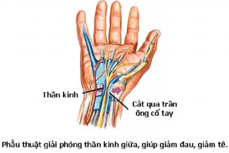 Điều trị hội chứng ống cổ tay như thế nào