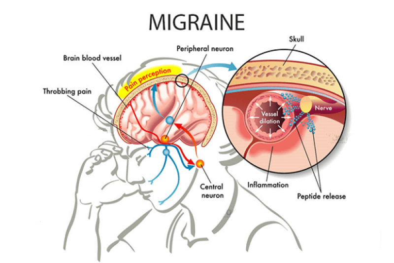 Điều trị triệu chứng đau nhói một bên đầu - đau nửa đầu ra sao
