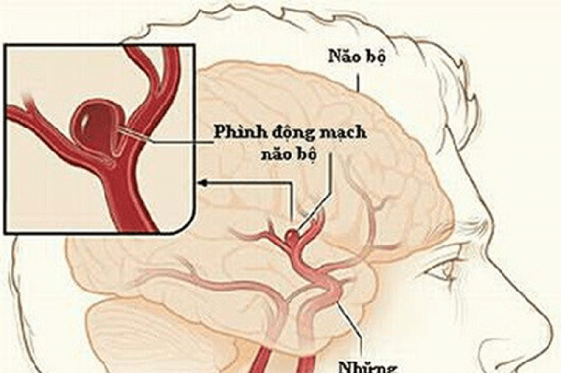 Điều trị vật lý cho bệnh nhân bị tai biến mạch máu não Điều trị vật lý cho bệnh nhân bị tai biến mạch máu não