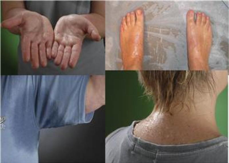 Mồ hôi tay - chân, tăng tiết mồ hôi, Hyperhydrosis