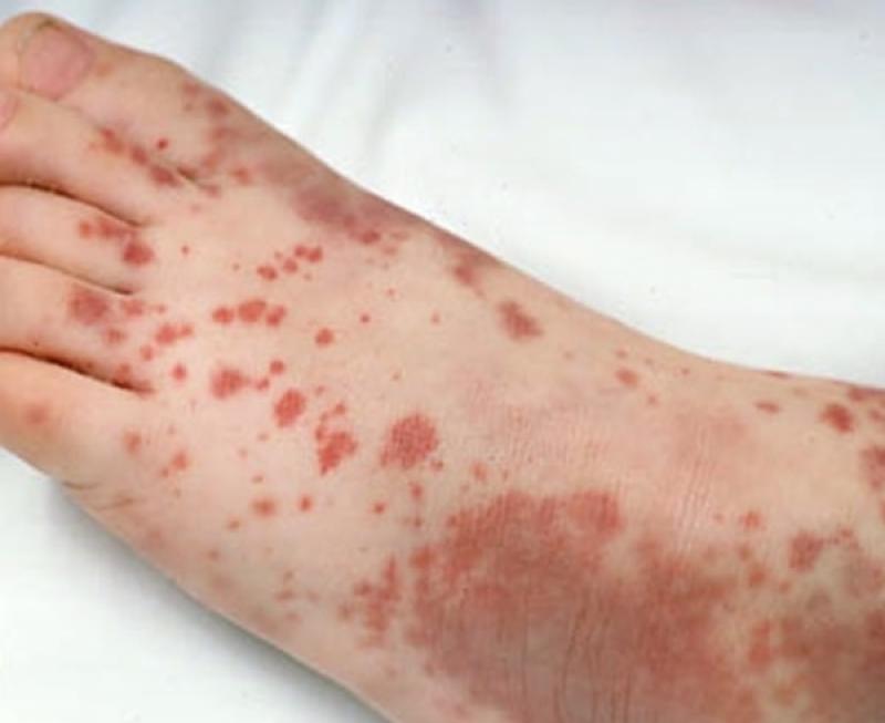 Đốm xuất huyết là dấu hiệu của bệnh gì?