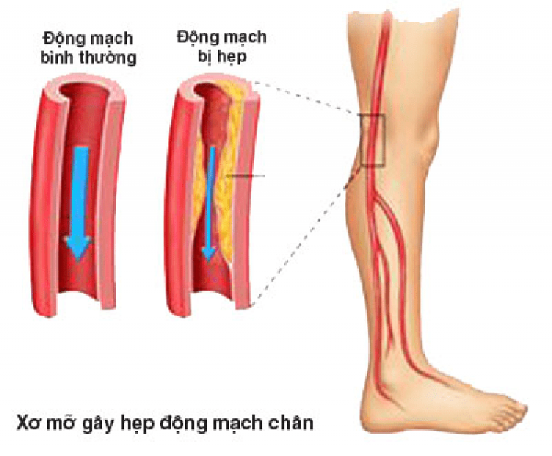Động mạch ngoại biên