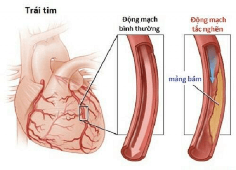 Động mạch vành