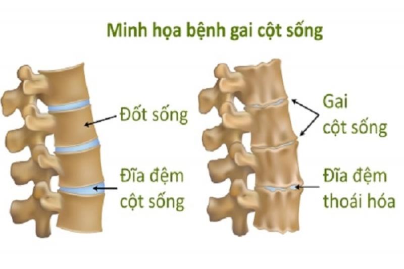 Gai cột sống