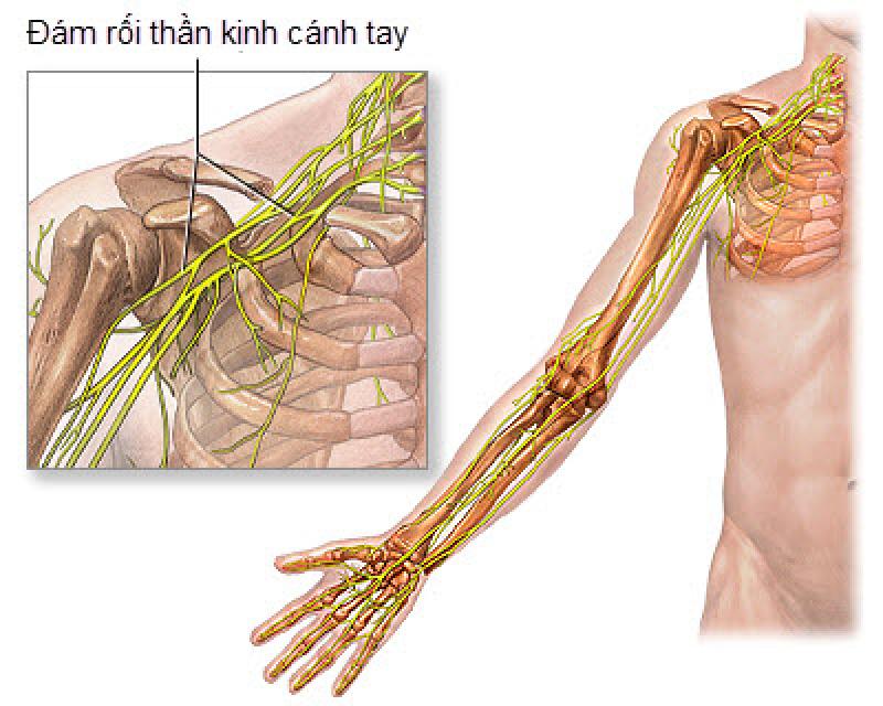 Co giật cơ cánh tay - Nguyên nhân và Cách phòng ngừa