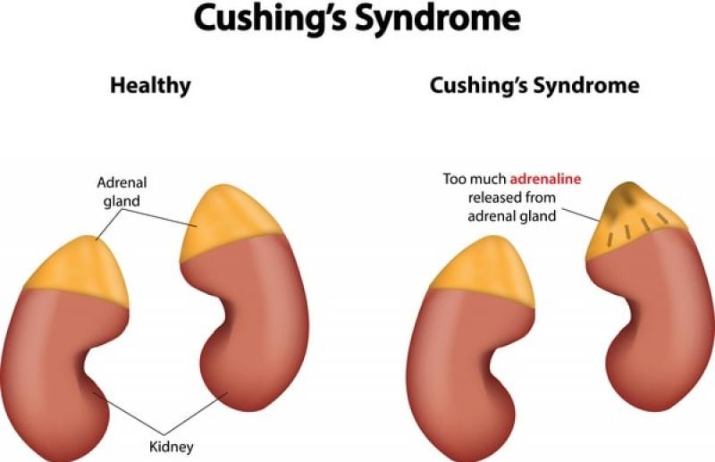 Hội chứng Cushing