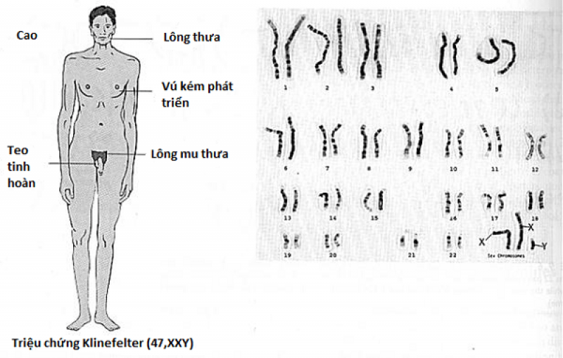 Hội chứng Klinefelter
