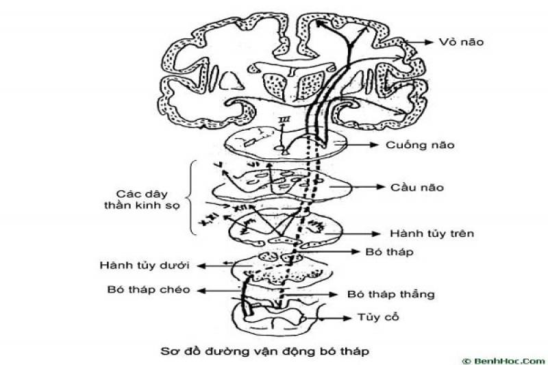 Hội chứng liệt nửa người