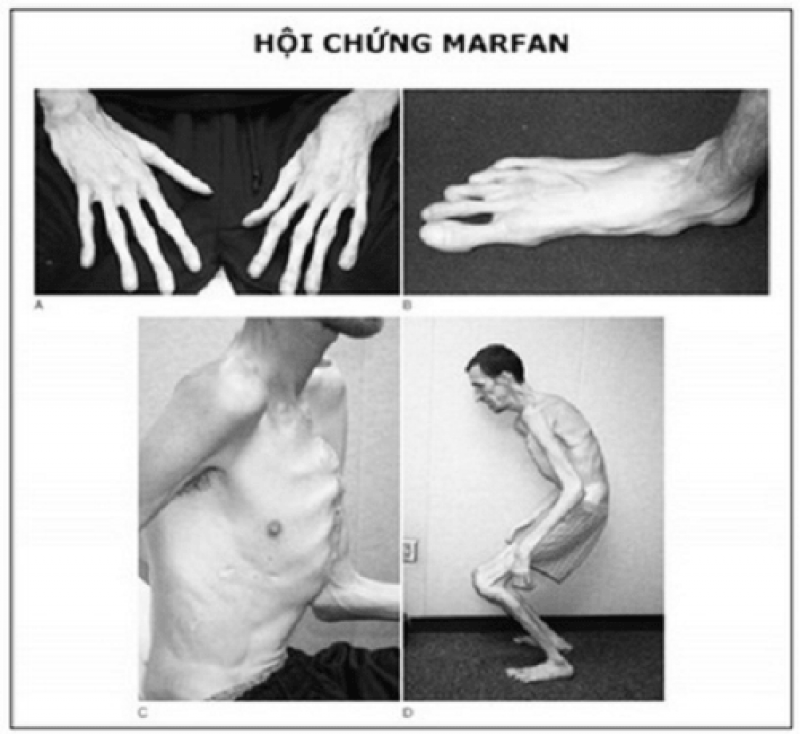 Hội chứng Marfan