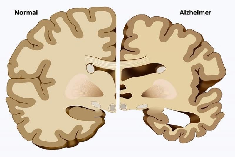 Alzheimer